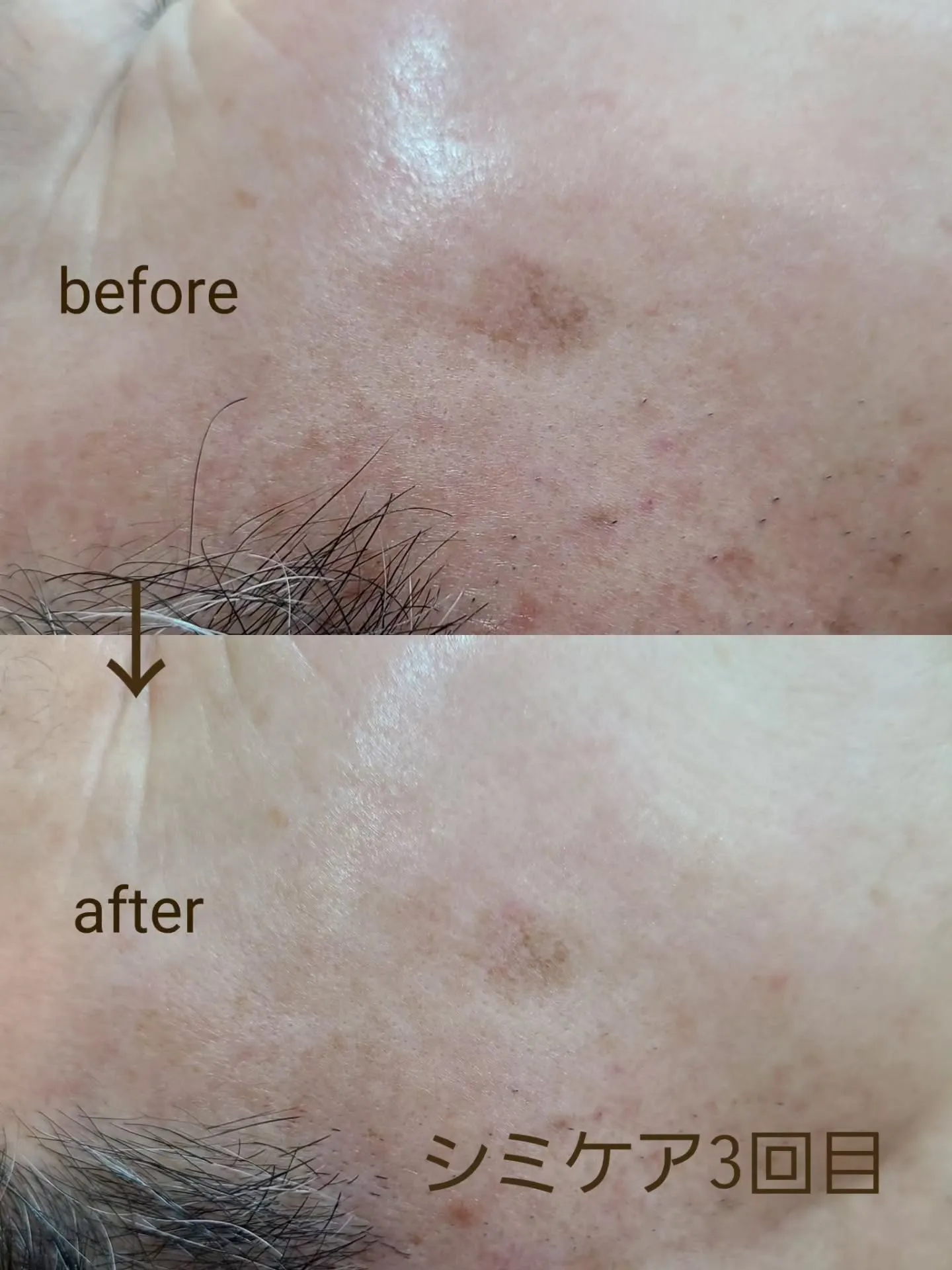 Merciのシミケア３回目の効果【大きなシミ】