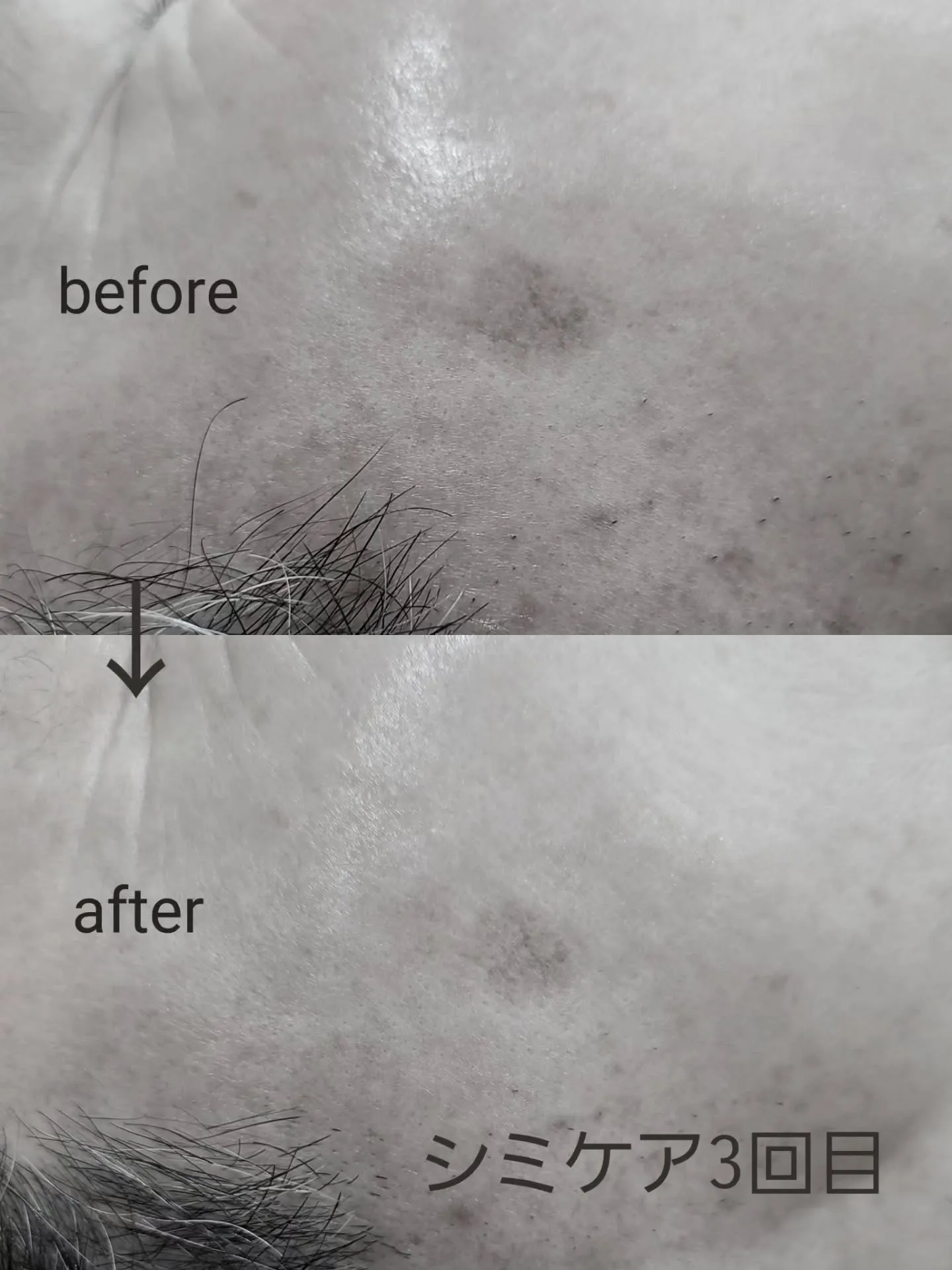 Merciのシミケア3回目の効果【大きなシミ】